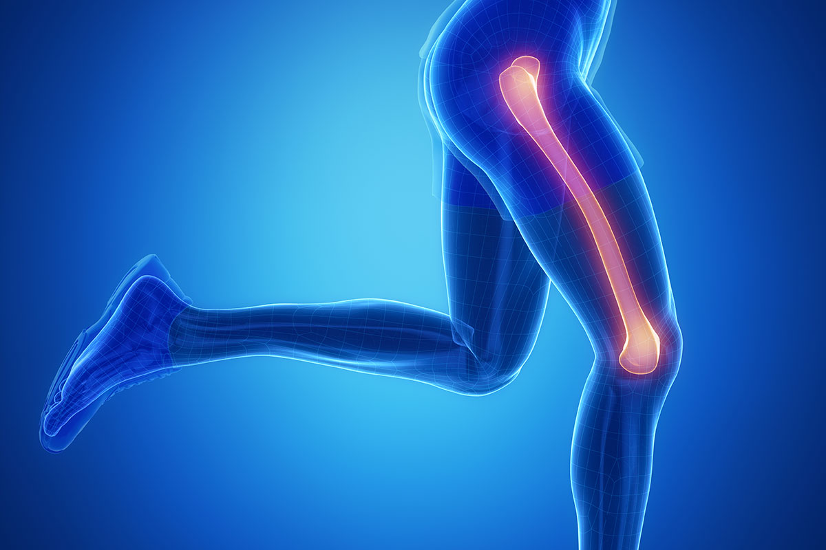 Oberschenkelbruch Bei Senioren: Wie Lang Ist Die Heilungsdauer?